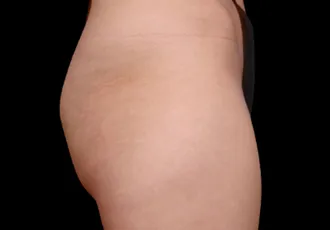 BA-EMsculpt-1B