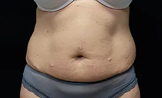 Mummy-tummy-before