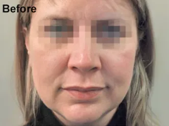 Profhilo-Face-3_before