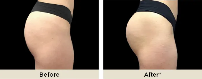 beforeafter_emsculptneo6