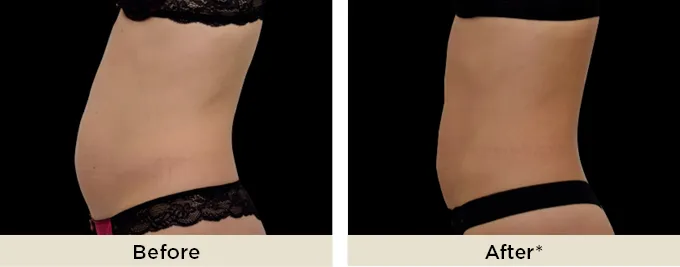 beforeafter_emsculptneo9