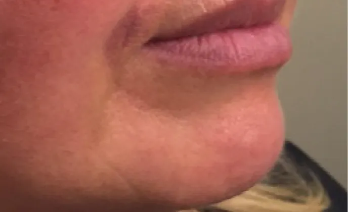 Non-surgical-1-after