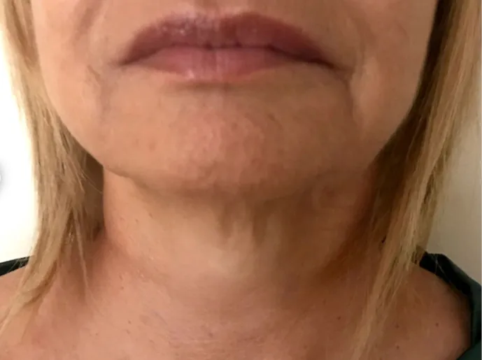 Non-surgical-12-after