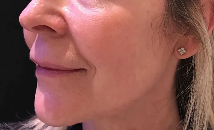 Non-surgical-3-after