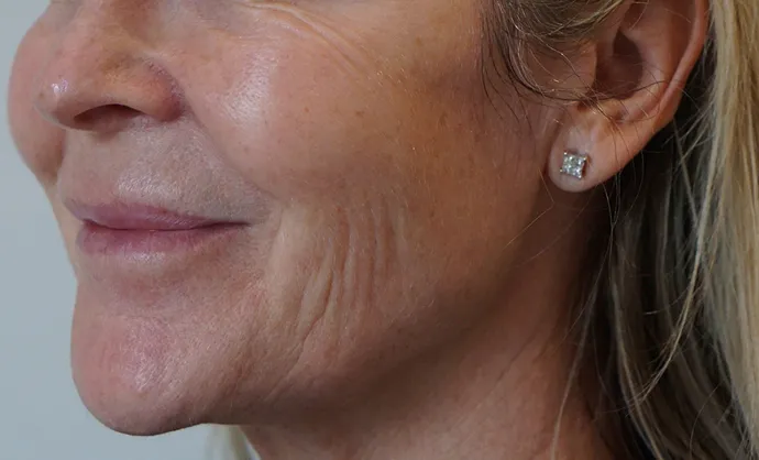 Non-surgical-3-before