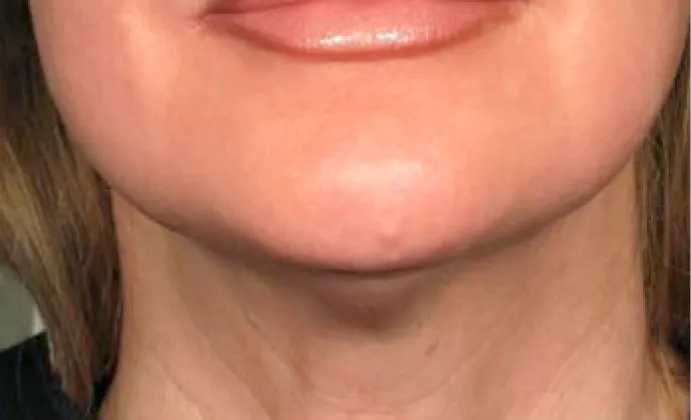Non-surgical-4-after