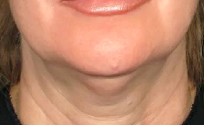 Non-surgical-4-before