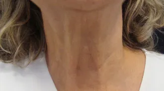 Non-surgical-6-after