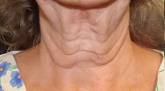 Non-surgical-6-before