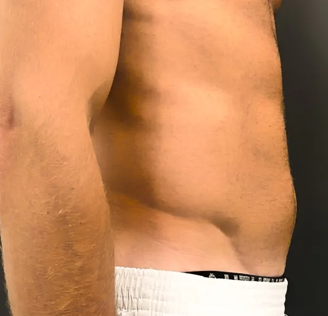 Abdominal-Dr.-Virginia-Benitez-Roig-1-After-6-sessions