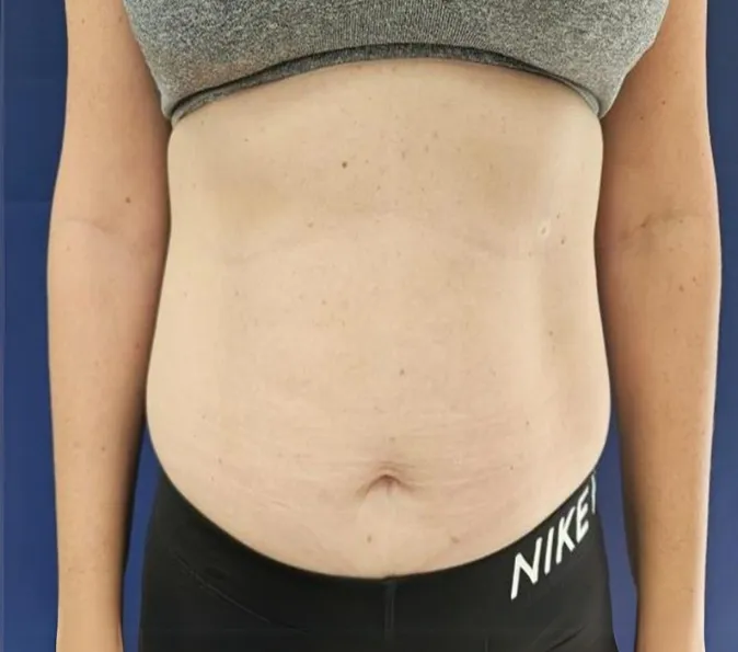 Abdominal-Sofwave-Clinic-after-p229-1