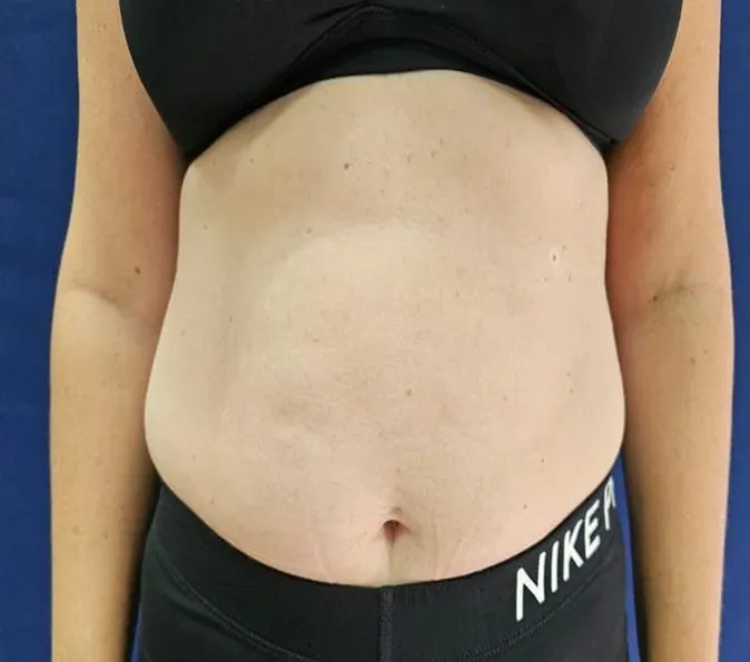 Abdominal-Sofwave-Clinic-before-p228