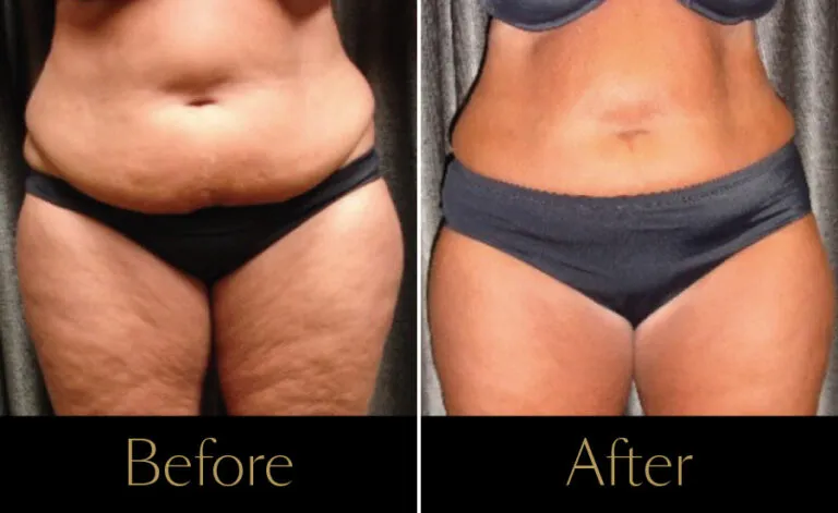 Emerald-Before–After