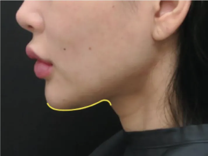 UltracelQ+ After - Rakus Clinic