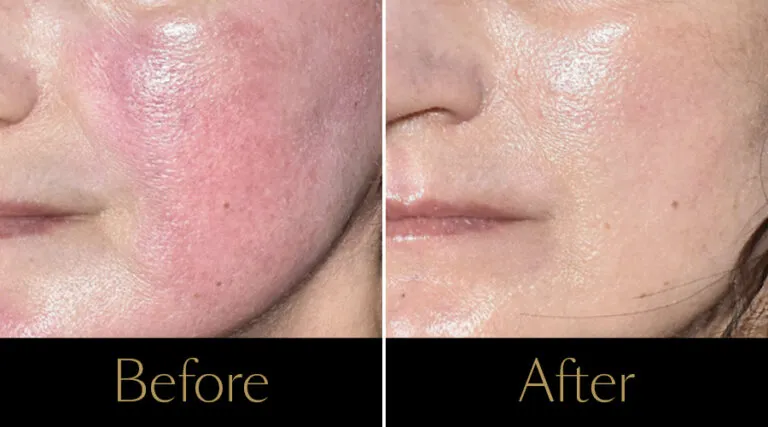 advatx-before-after1