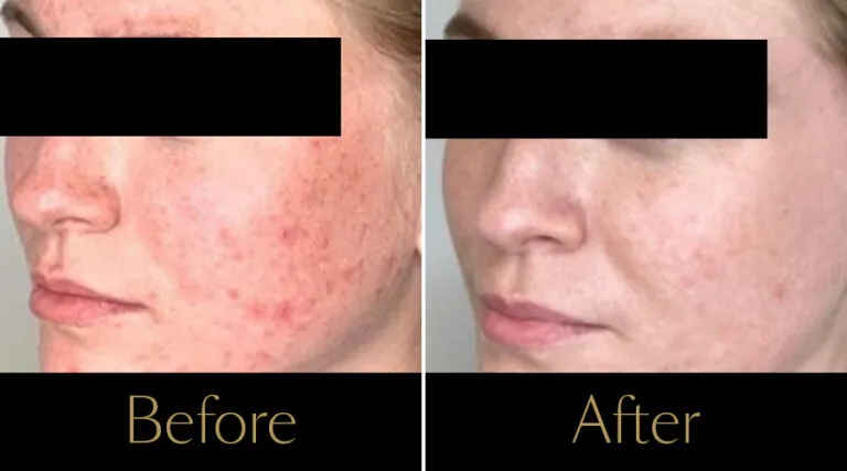 advatx-before-after13