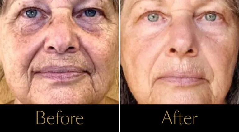 advatx-before-after16
