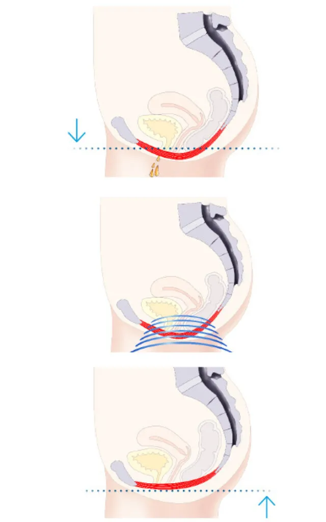 Emsella-treatment-benefits