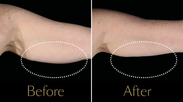 neo-beforeafter2