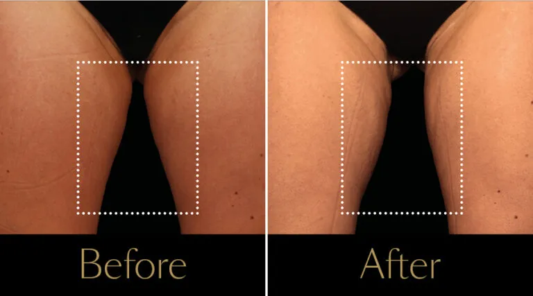 neo-beforeafter3