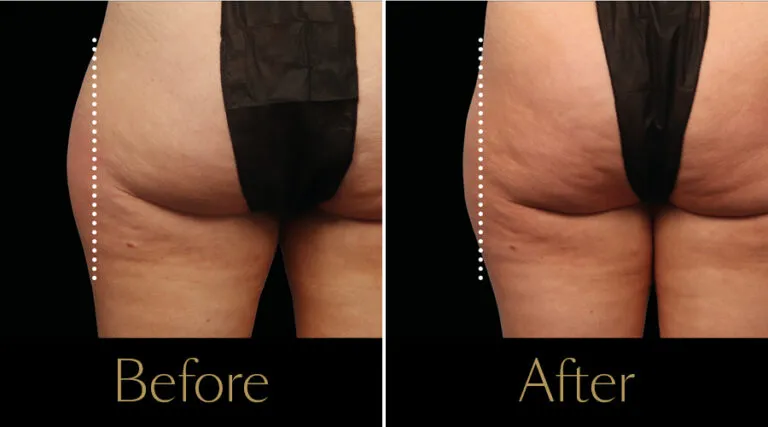 neo-beforeafter4