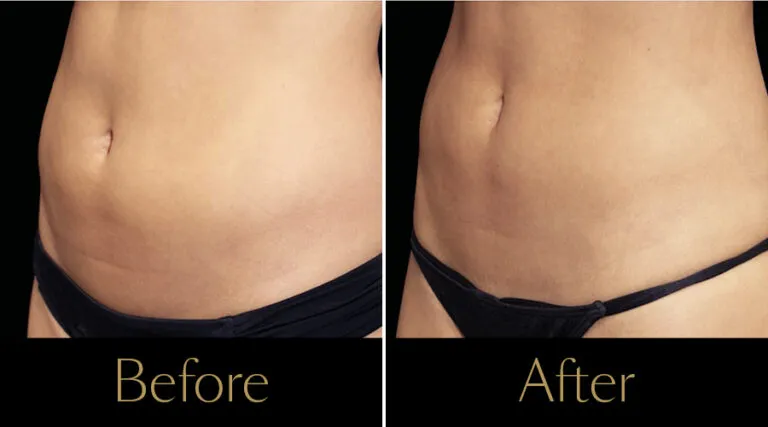 neo-beforeafter6