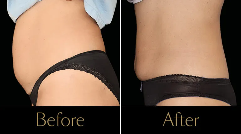 neo-beforeafter7