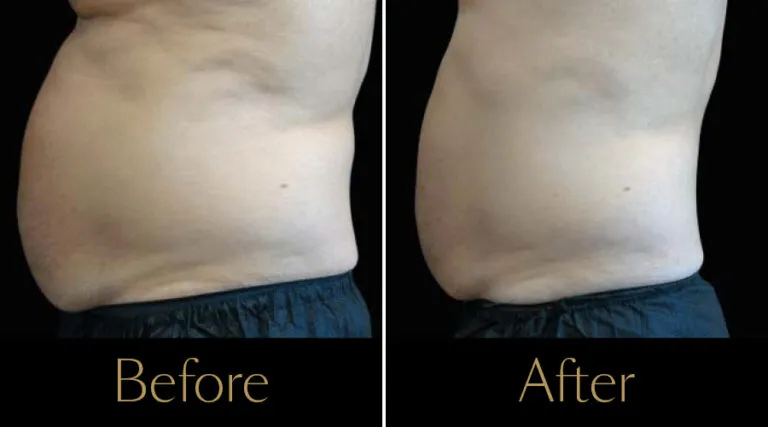 neo-beforeafter8