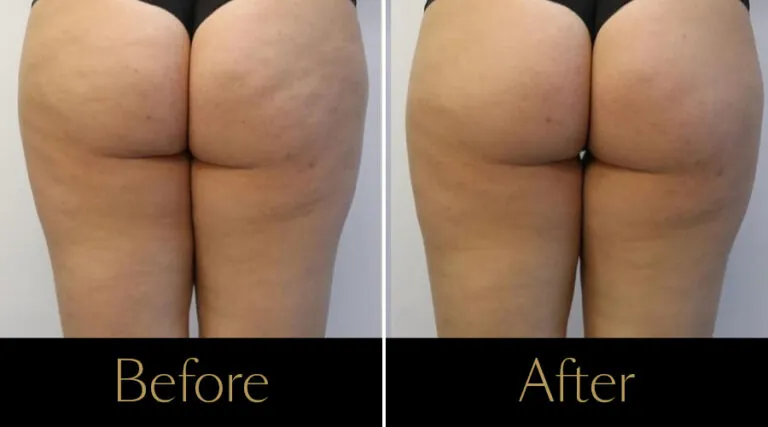 rakus-beforeafter-cellution-gallery2