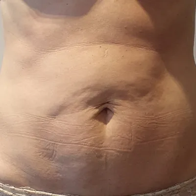 rakus-beforeafter-cellution5