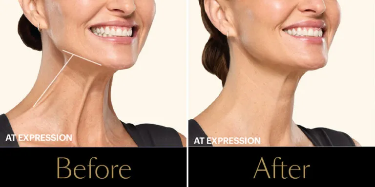 rakus-botox-beforeafter-gallery