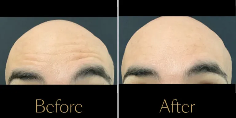 rakus-botox-beforeafter-gallery2