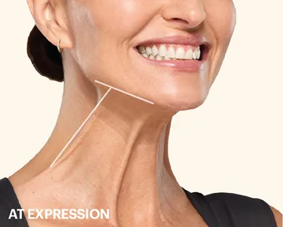 rakus-botox-gallery