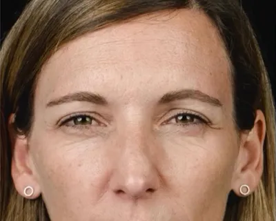 rakus-botox-gallery4