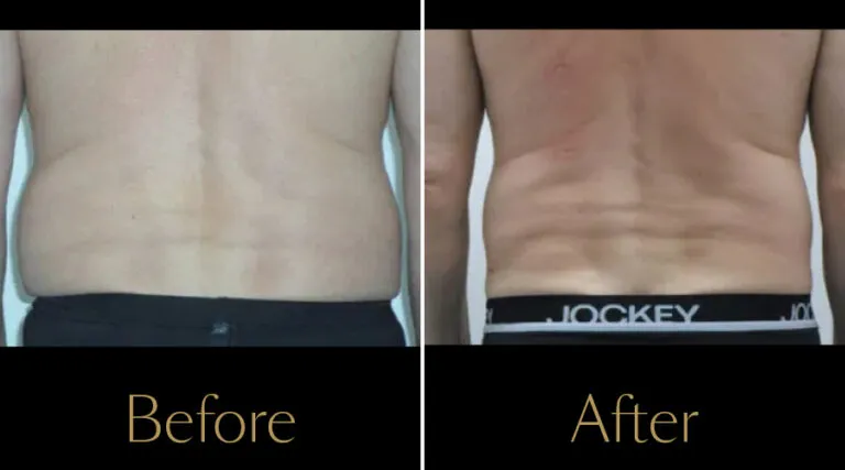 rakus-cristalpro-beforeafter-gallery3
