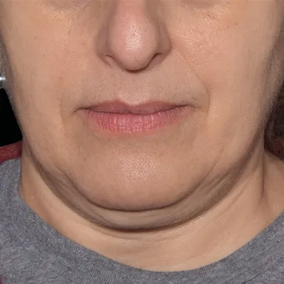 rakus-emface-beforeafter5