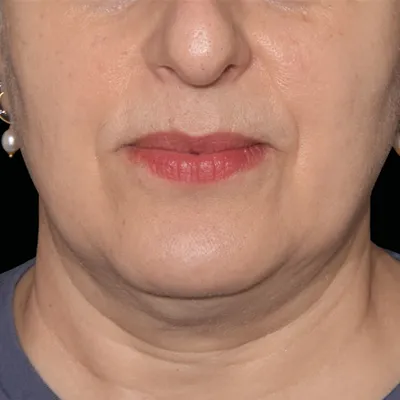 rakus-emface-beforeafter6