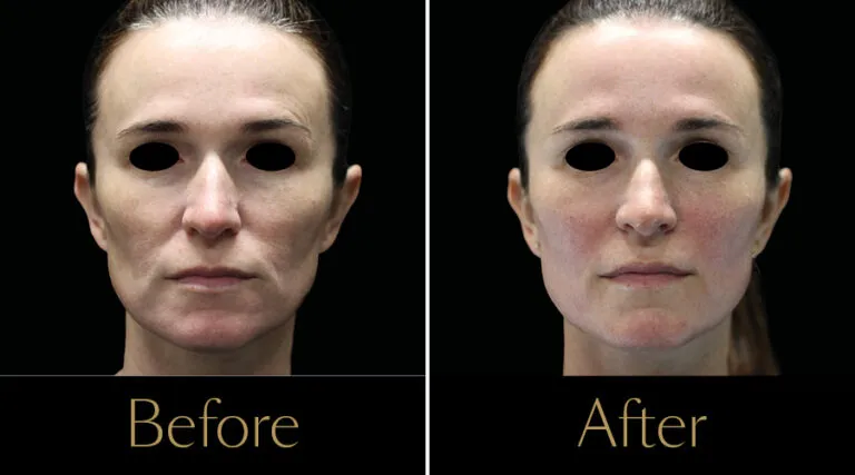 rakus-emface-beforeaftergallery5