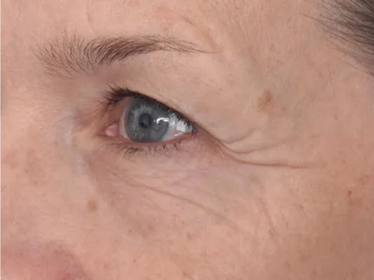 rakus-hydrafacial-beforeafter
