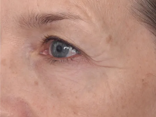 rakus-hydrafacial-beforeafter2