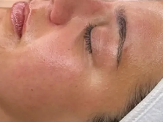 rakus-hydrafacial-beforeafter4