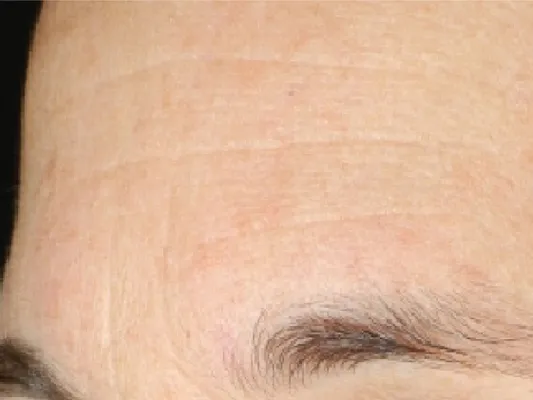 rakus-hydrafacial-beforeafter5