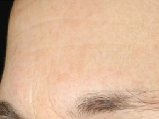 rakus-hydrafacial-beforeafter6