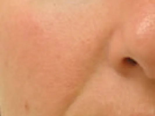 rakus-hydrafacial-beforeafter7
