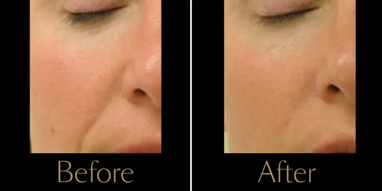 rakus-hydrafacial-gallery2