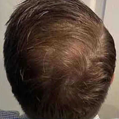 rakus-keravive-beforeafter2