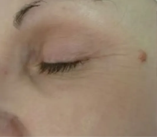 rakus-pelleve-beforeafter-eyes3