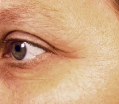 rakus-pelleve-beforeafter2
