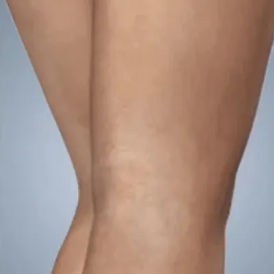rakus-sclerotherapy-ba2