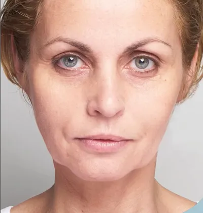 rakus-threadlift-beforeafter